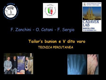 Tailor’s bunion e V dito varo TECNICA PERCUTANEA F. Zanchini - O. Catani - F. Sergio.