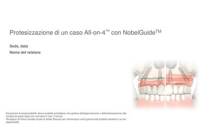 Protesizzazione di un caso All-on-4™ con NobelGuideTM