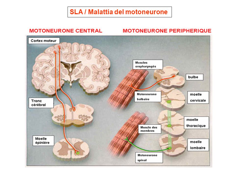 SLA / Malattia del motoneurone