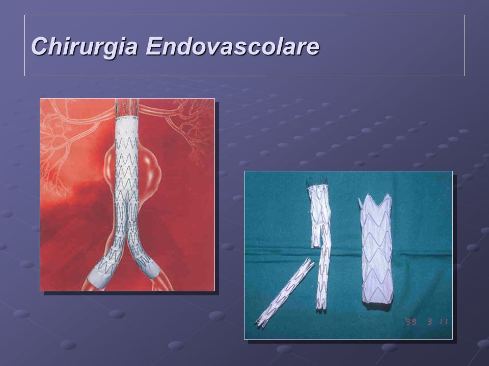 Chirurgia Endovascolare