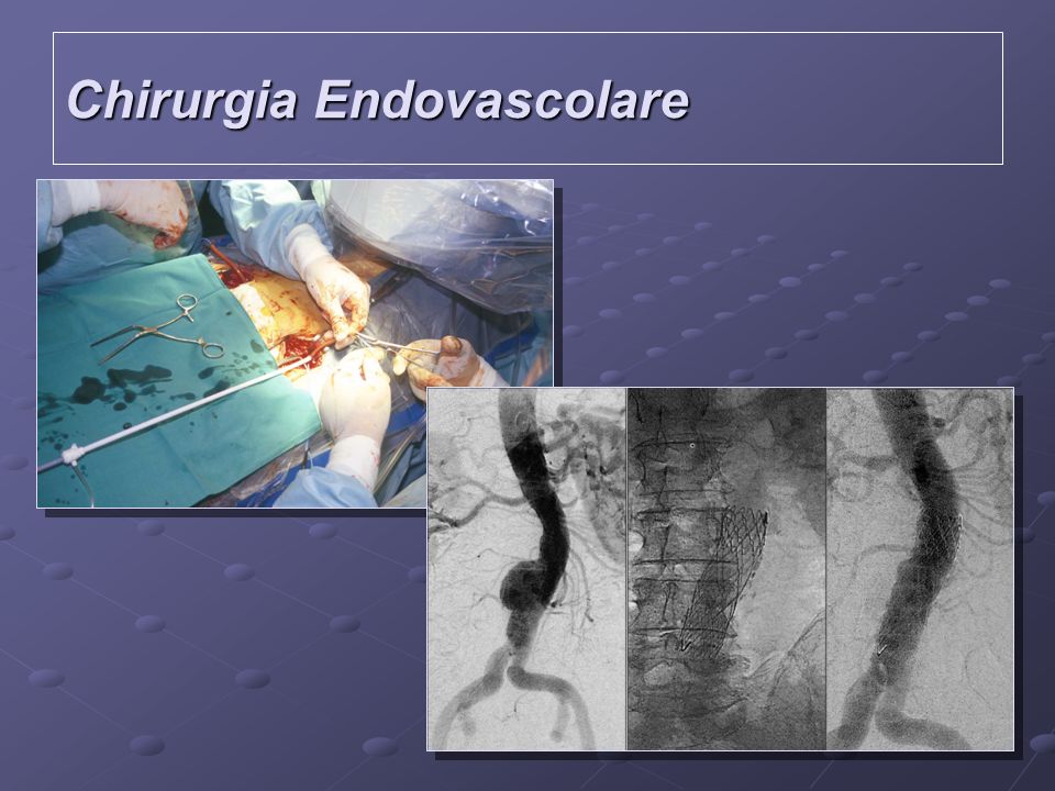 Chirurgia Endovascolare