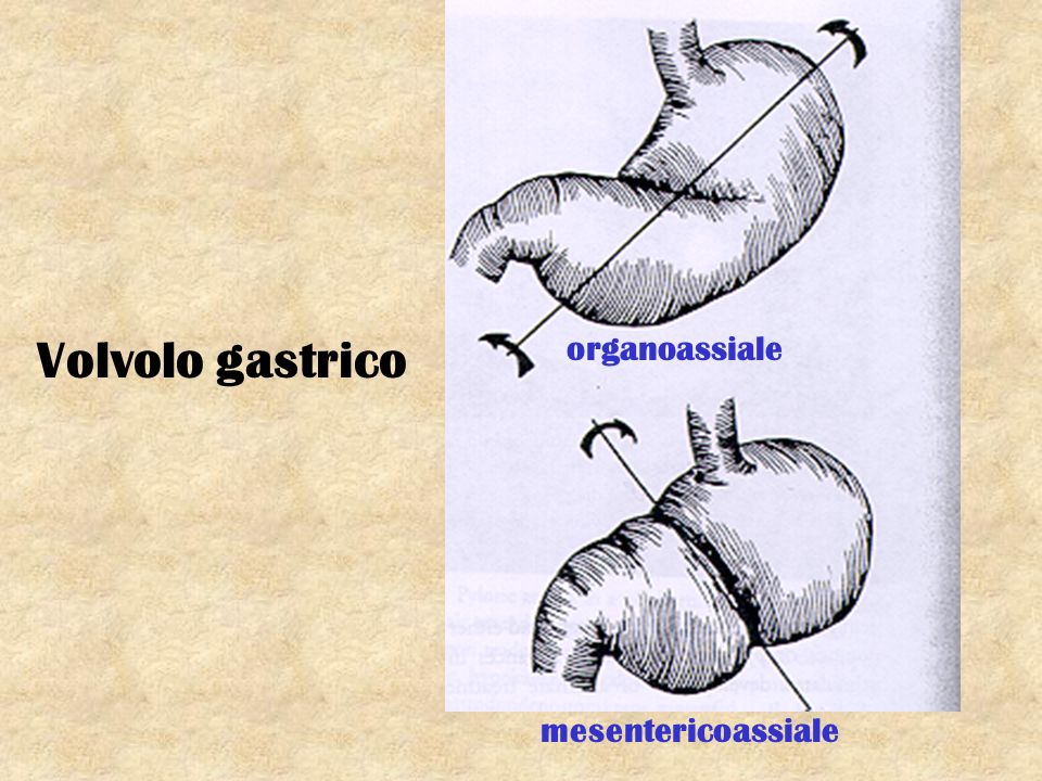 Volvolo gastrico organoassiale mesentericoassiale