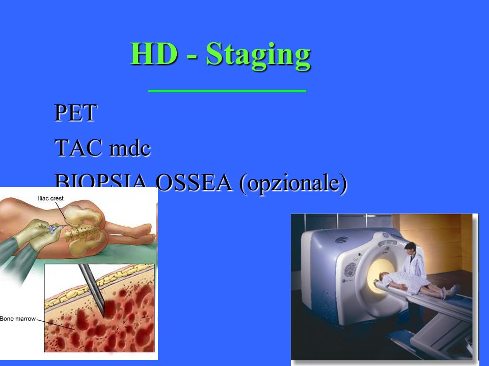 HD - Staging PET TAC mdc BIOPSIA OSSEA (opzionale)