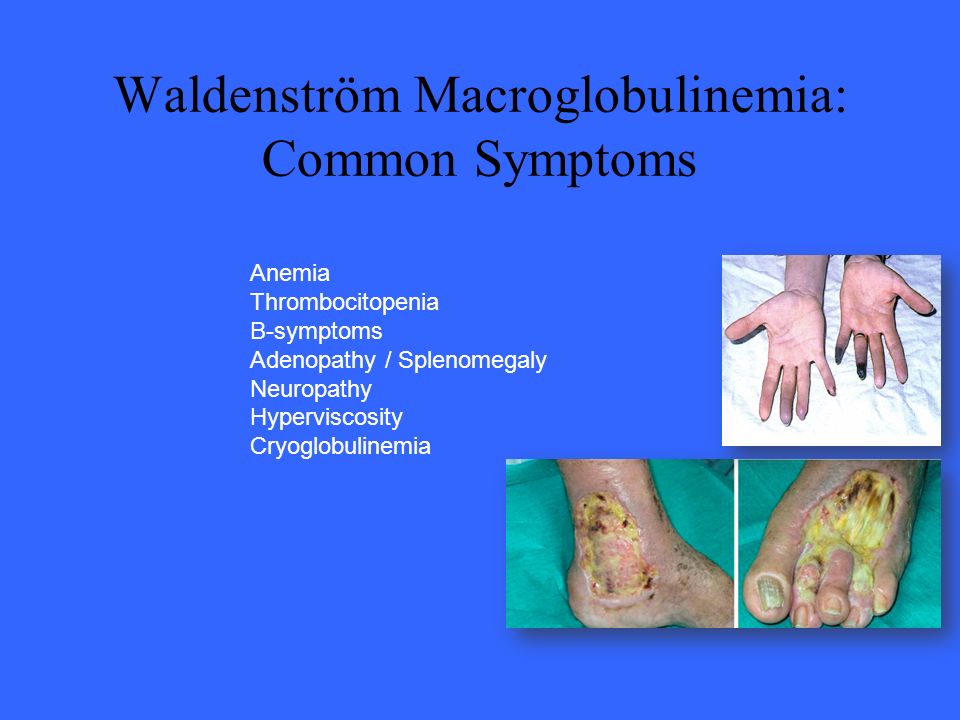 Waldenström Macroglobulinemia: Common Symptoms
