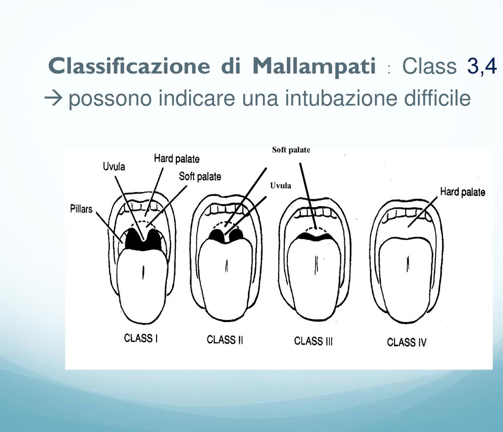 Classificazione di Mallampati : Class 3,4  possono indicare una intubazione difficile