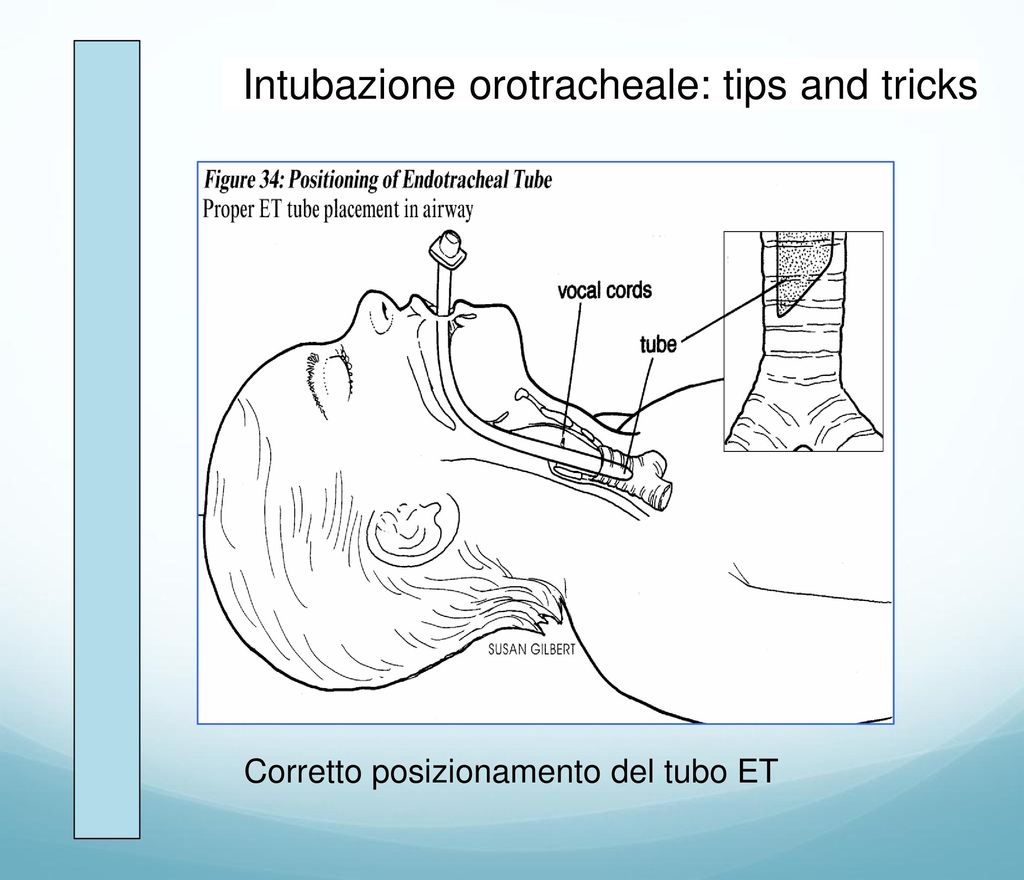 Intubazione orotracheale: tips and tricks