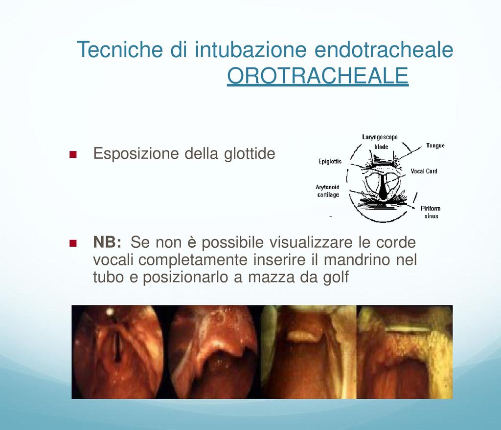 Tecniche di intubazione endotracheale OROTRACHEALE