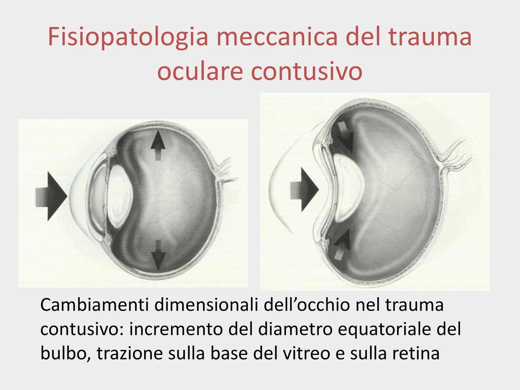 Fisiopatologia meccanica del trauma oculare contusivo