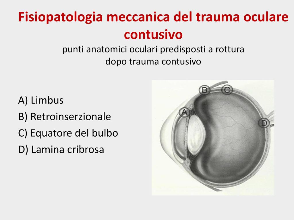 Fisiopatologia meccanica del trauma oculare contusivo punti anatomici oculari predisposti a rottura dopo trauma contusivo
