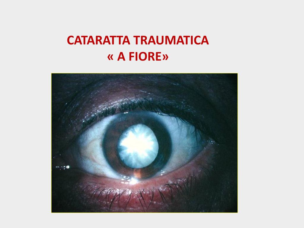 CATARATTA TRAUMATICA « A FIORE»