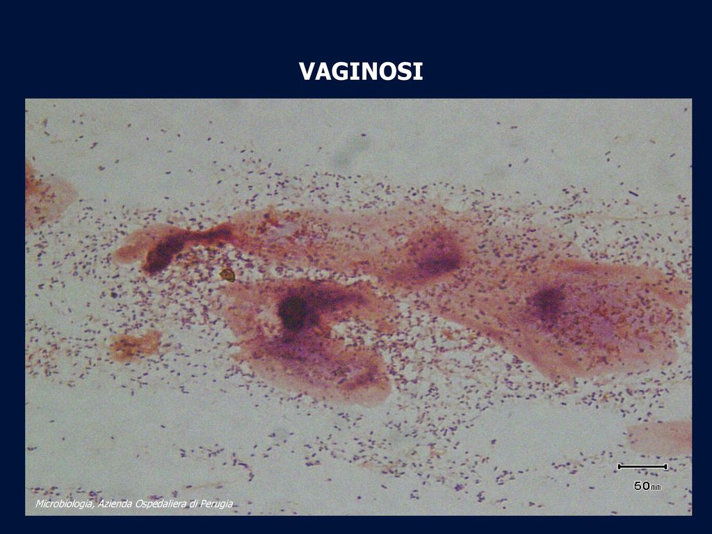 VAGINOSI Microbiologia, Azienda Ospedaliera di Perugia