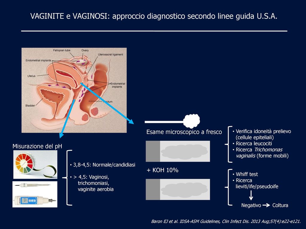 VAGINITE e VAGINOSI: approccio diagnostico secondo linee guida U.S.A.