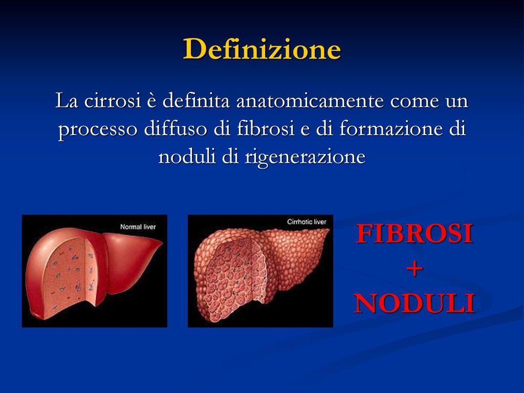 Definizione FIBROSI + NODULI