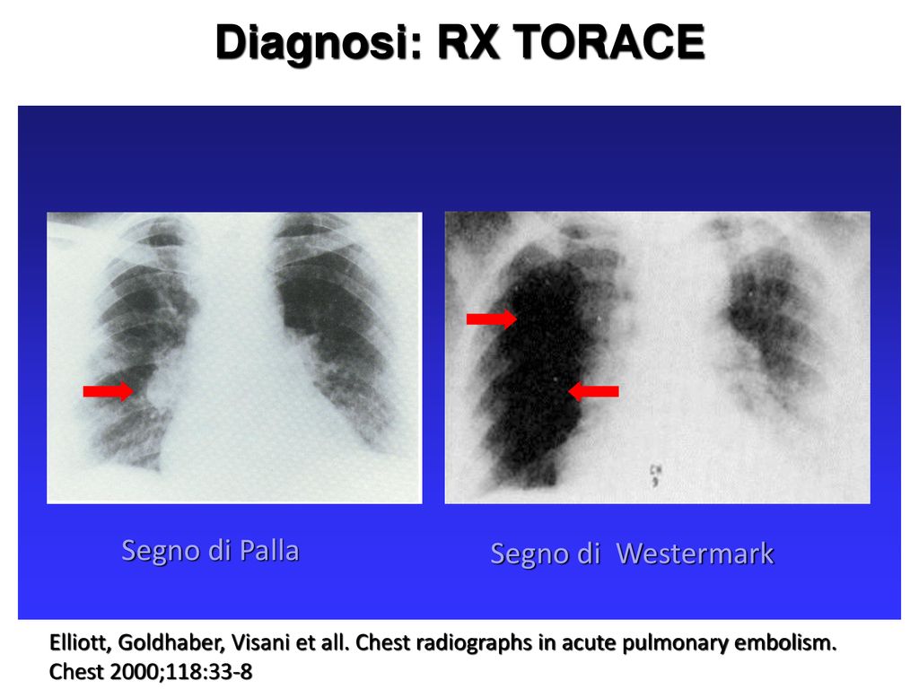 Il dolore toracico, caso clinico - ppt scaricare