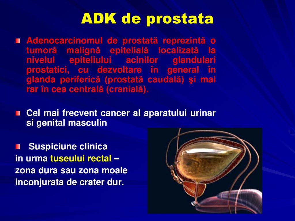 Adenomul de prostata vs. cancerul de prostata