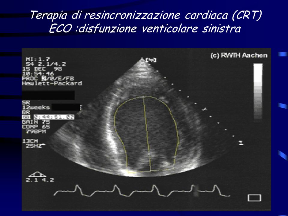 Terapia di resincronizzazione cardiaca (CRT) ECO :disfunzione venticolare sinistra