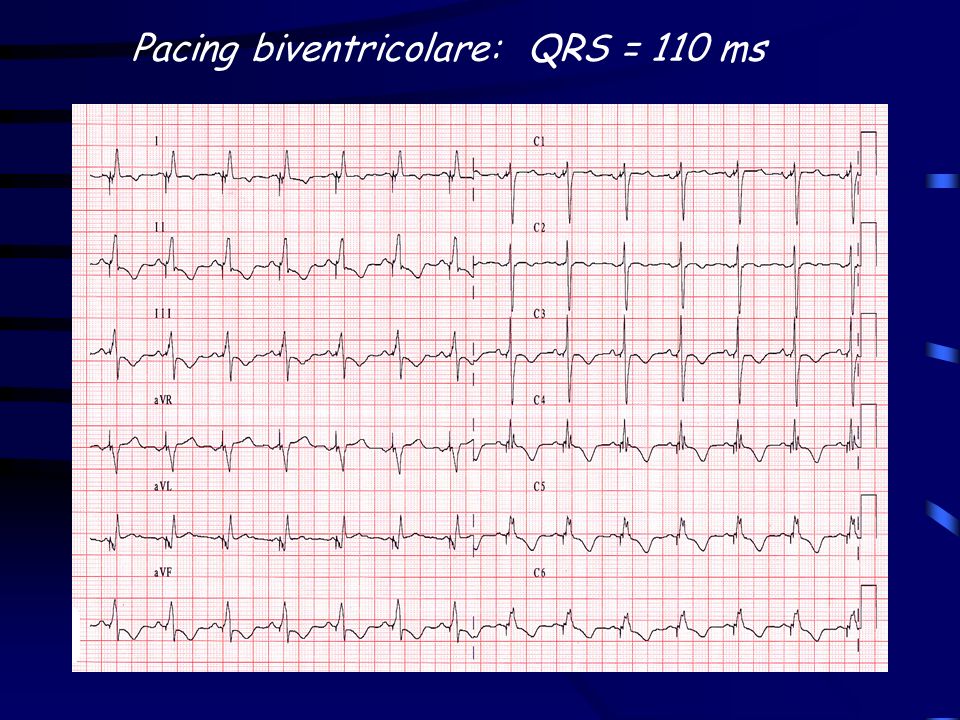 Pacing biventricolare: QRS = 110 ms