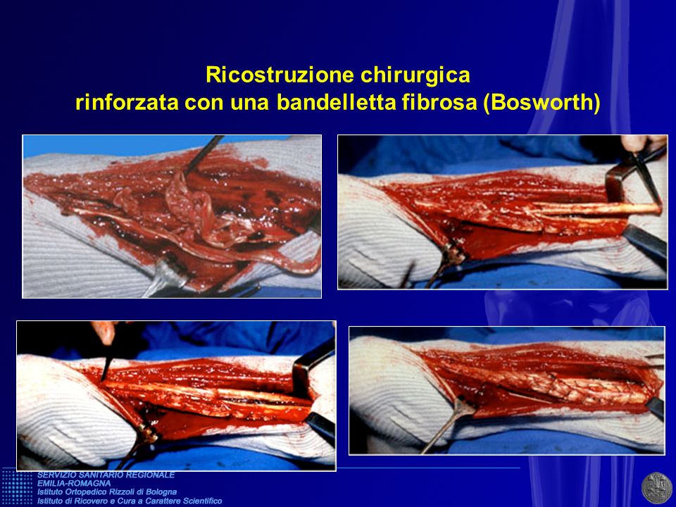 Ricostruzione chirurgica rinforzata con una bandelletta fibrosa (Bosworth)