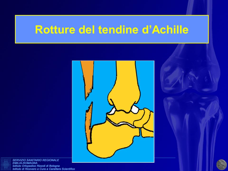 Rotture del tendine d’Achille