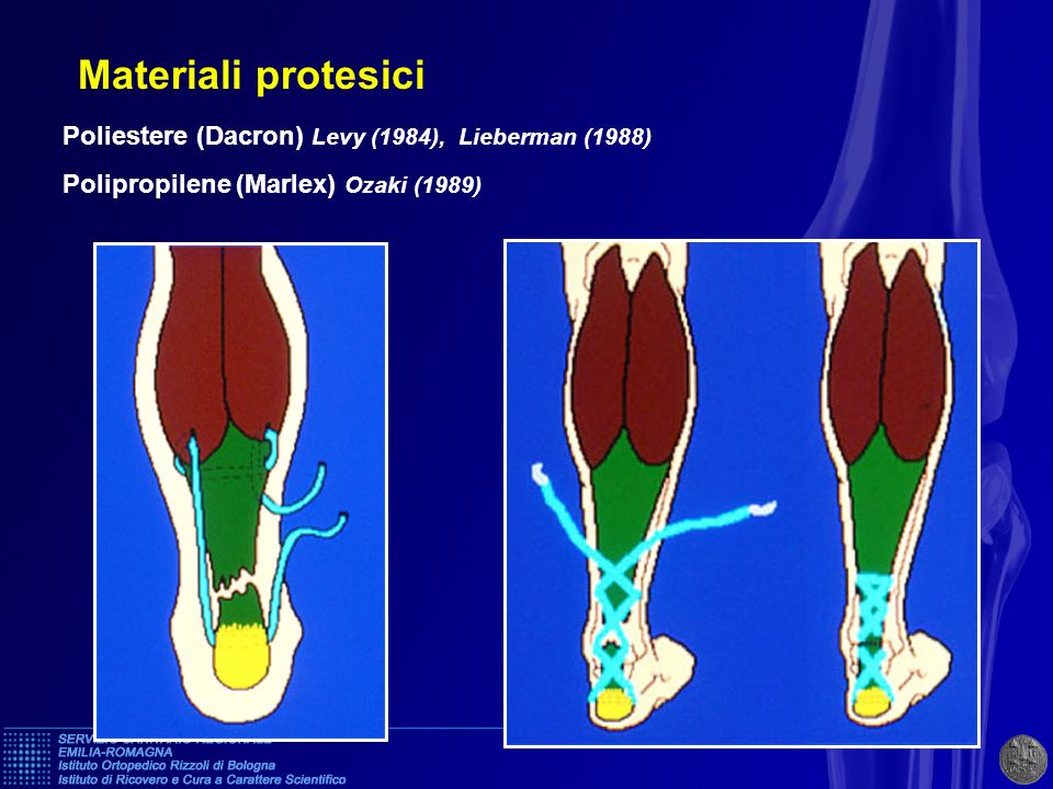 Materiali protesici Poliestere (Dacron) Levy (1984), Lieberman (1988)