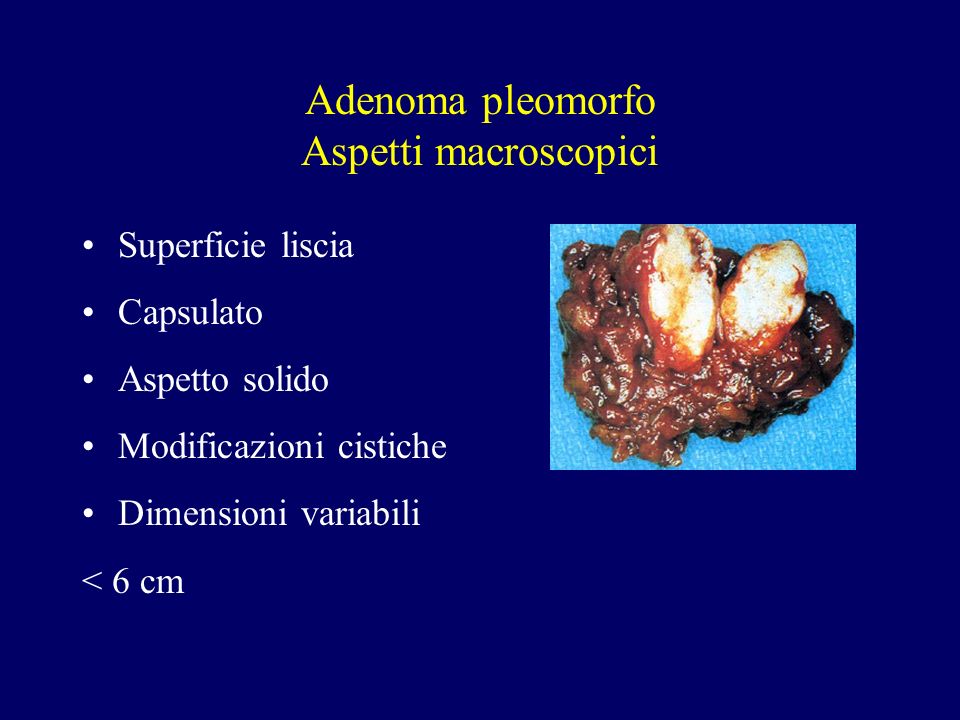 Adenoma pleomorfo Aspetti macroscopici