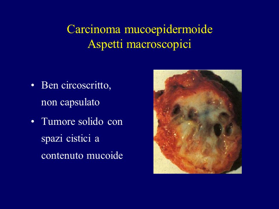 Carcinoma mucoepidermoide Aspetti macroscopici