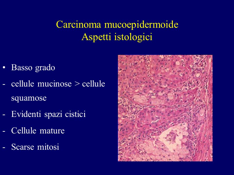 Carcinoma mucoepidermoide Aspetti istologici