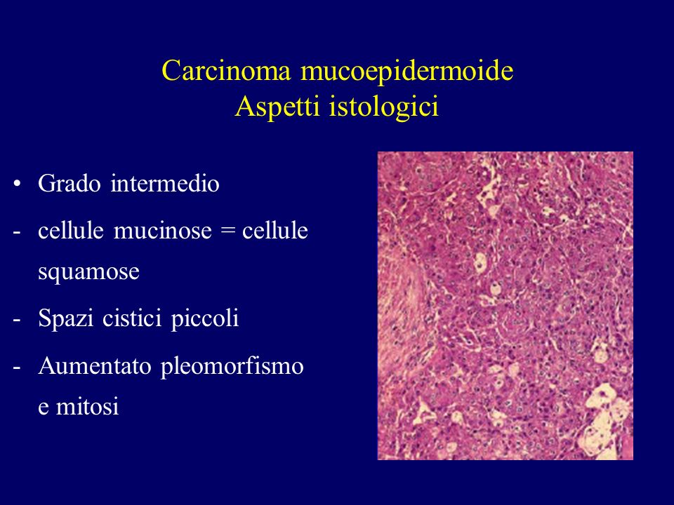 Carcinoma mucoepidermoide Aspetti istologici