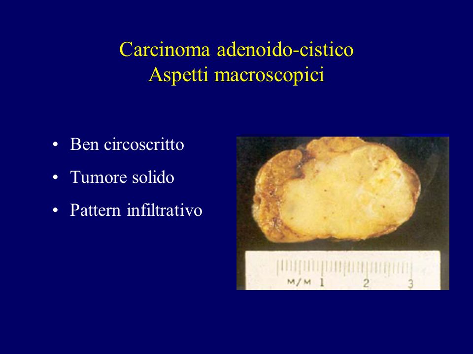 Carcinoma adenoido-cistico