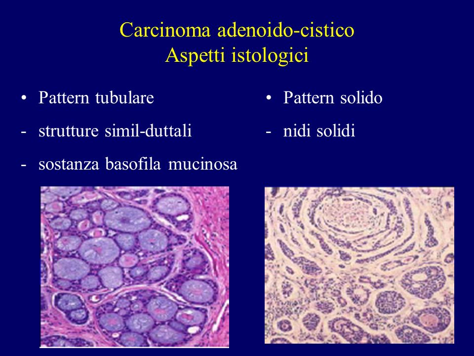 Carcinoma adenoido-cistico Aspetti istologici
