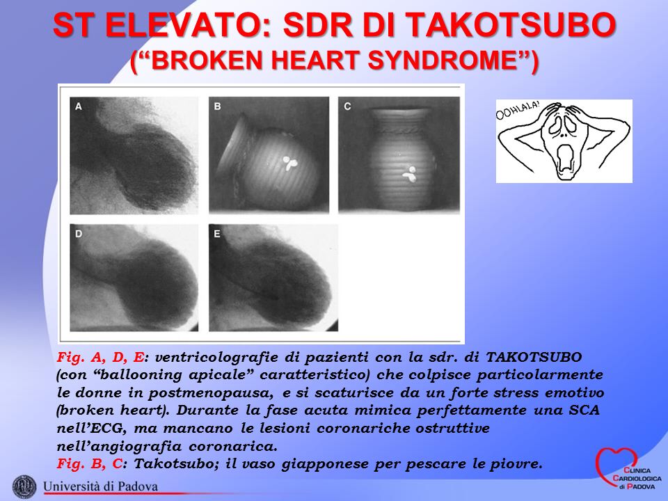 ST ELEVATO: SDR DI TAKOTSUBO ( BROKEN HEART SYNDROME )