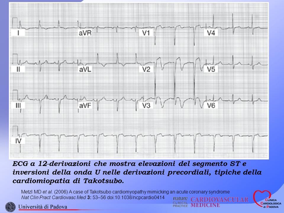 ECG a 12-derivazioni che mostra elevazioni del segmento ST e inversioni della onda U nelle derivazioni precordiali, tipiche della cardiomiopatia di Takotsubo.