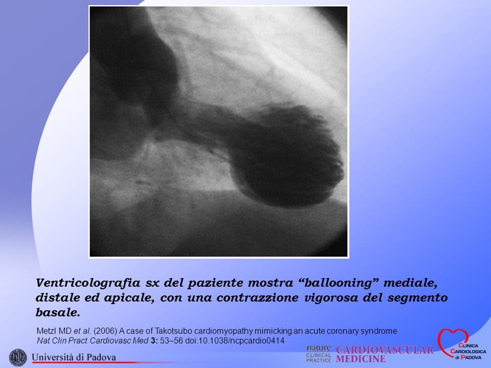 Ventricolografia sx del paziente mostra ballooning mediale, distale ed apicale, con una contrazzione vigorosa del segmento basale.