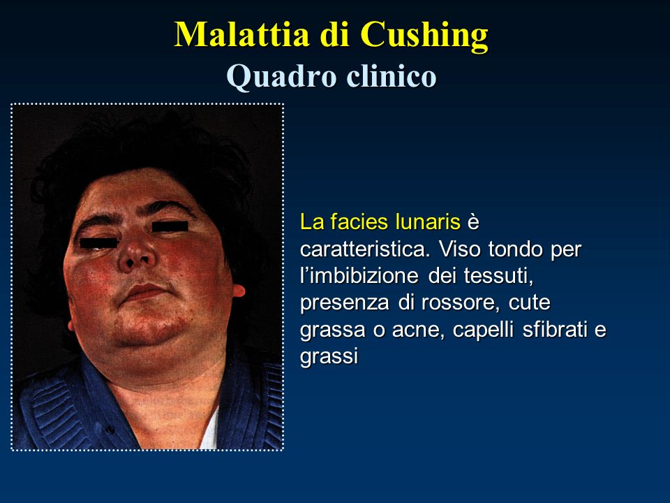 Malattia di Cushing Quadro clinico