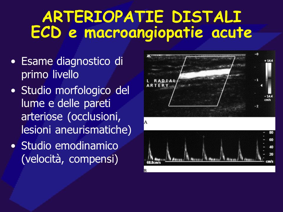 ECD e macroangiopatie acute