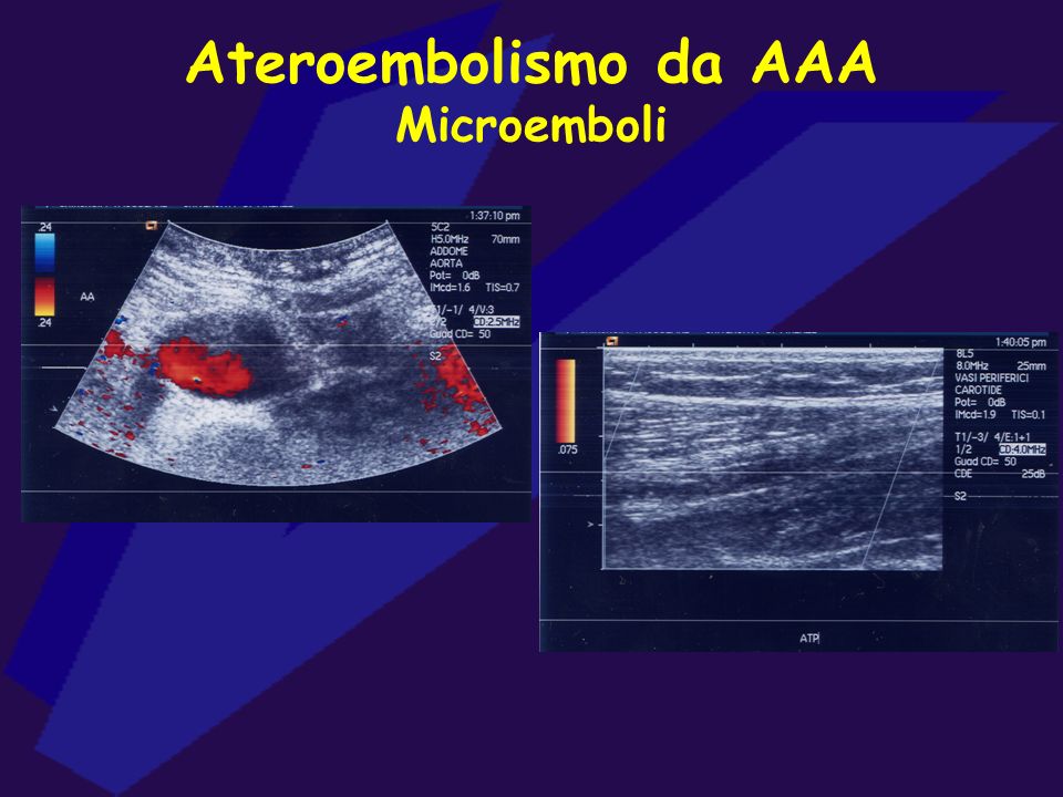 Ateroembolismo da AAA Microemboli