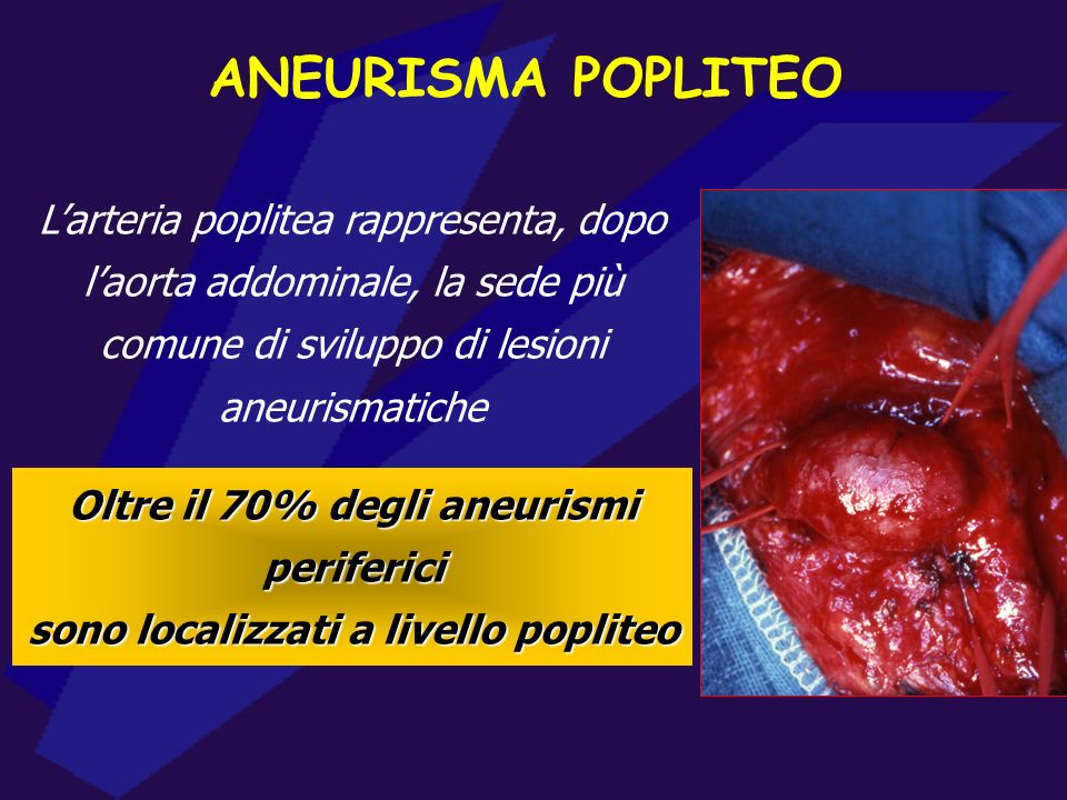 ANEURISMA POPLITEO L’arteria poplitea rappresenta, dopo l’aorta addominale, la sede più comune di sviluppo di lesioni aneurismatiche.