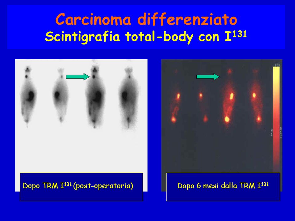Carcinoma differenziato Scintigrafia total-body con I131