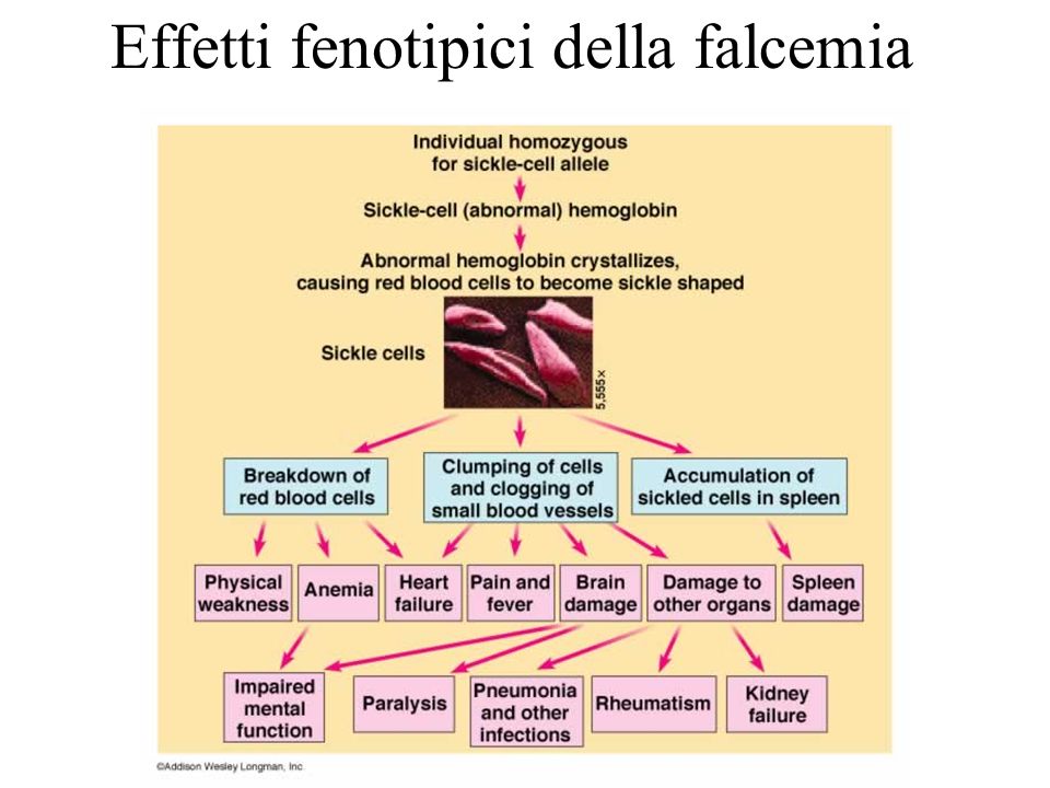 Effetti fenotipici della falcemia