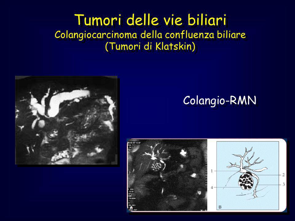 Tumori delle vie biliari Colangiocarcinoma della confluenza biliare (Tumori di Klatskin)