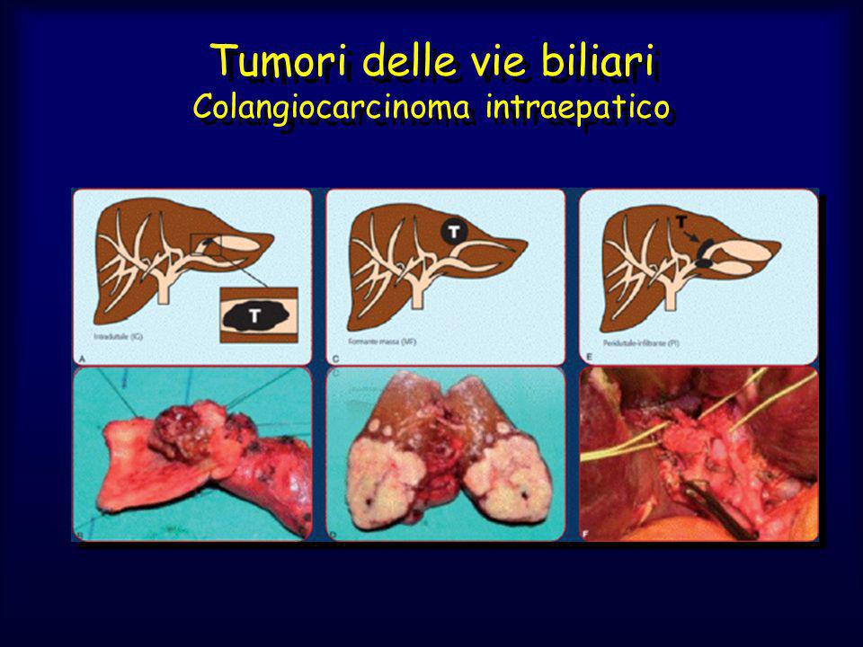 Tumori delle vie biliari Colangiocarcinoma intraepatico