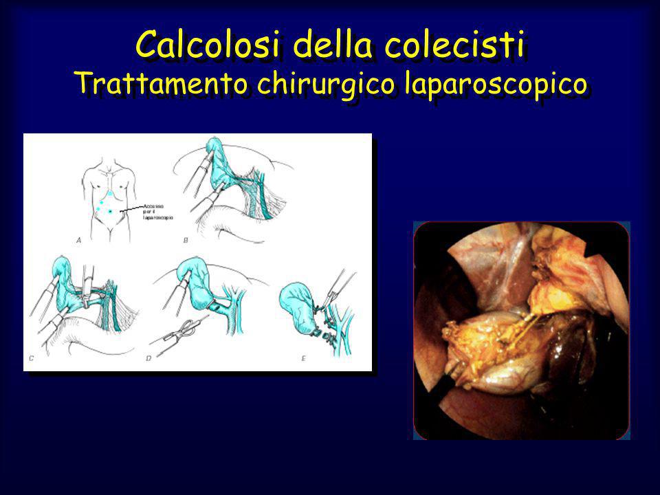 Calcolosi della colecisti Trattamento chirurgico laparoscopico
