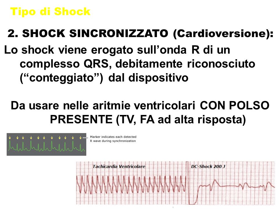 Tipo di Shock 2. SHOCK SINCRONIZZATO (Cardioversione):