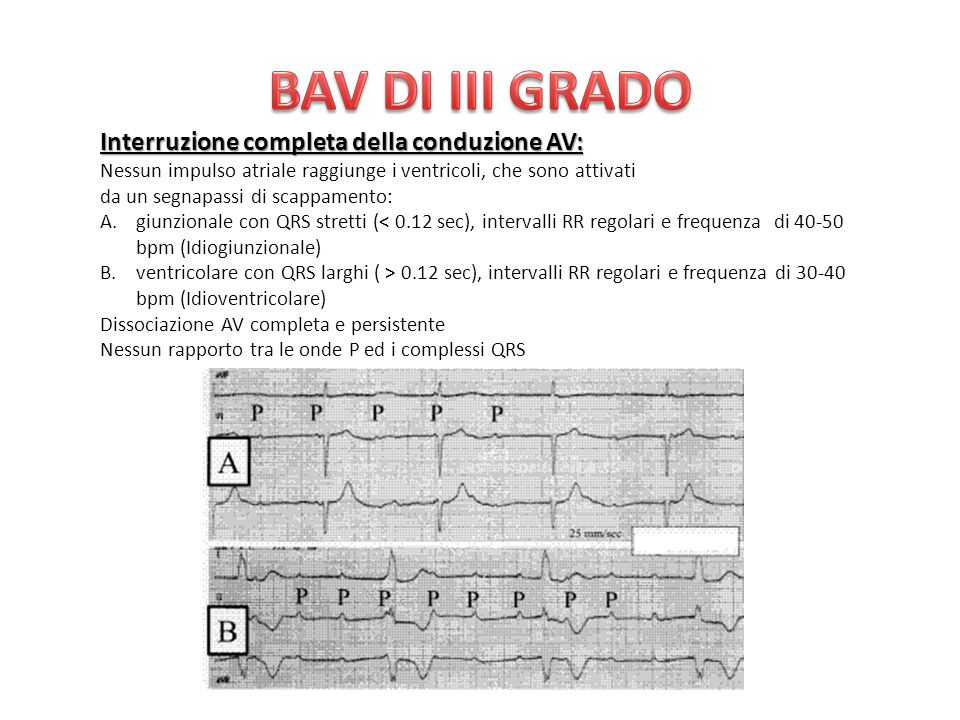 BAV DI III GRADO Interruzione completa della conduzione AV: