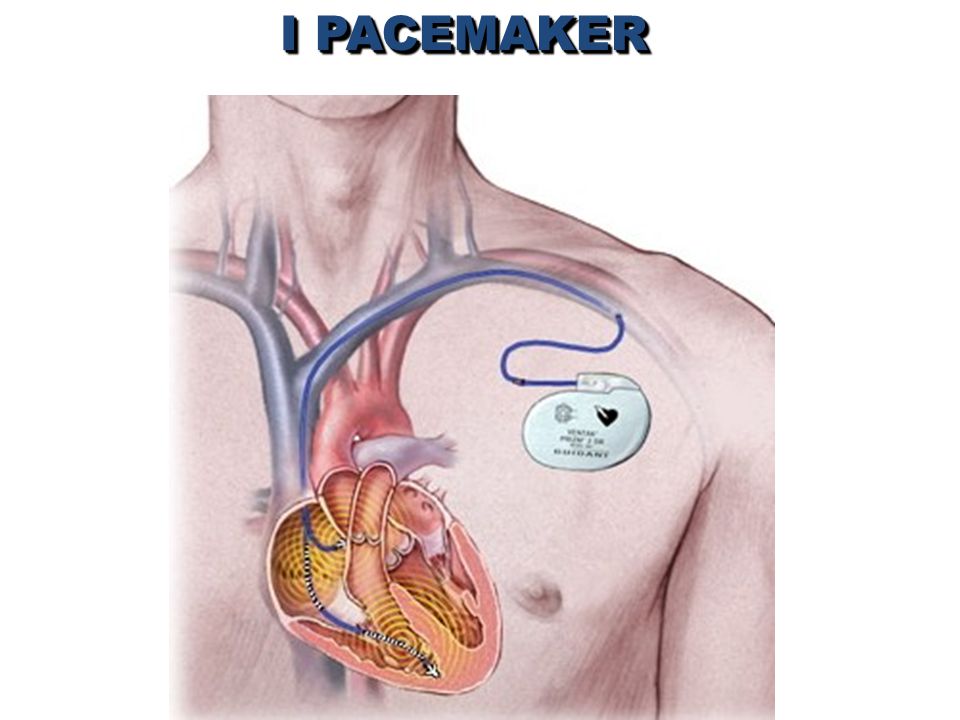 I PACEMAKER