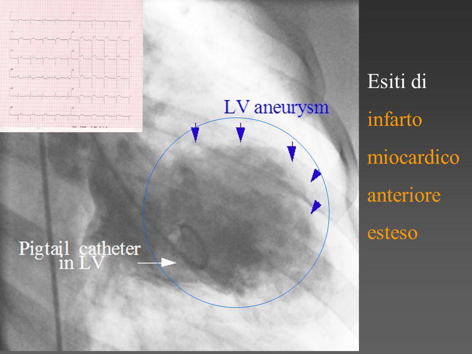 Esiti di infarto miocardico anteriore esteso