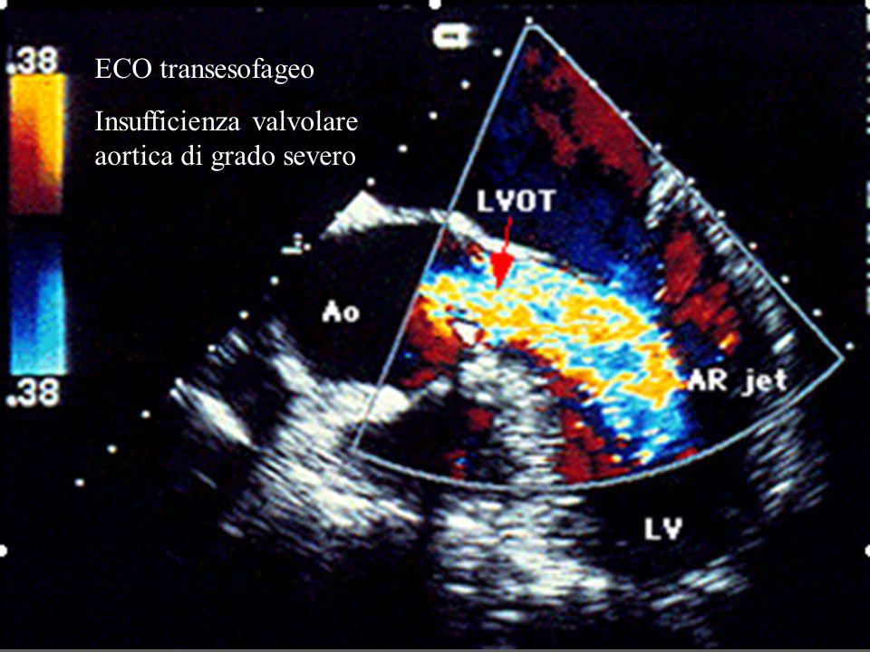 ECO transesofageo Insufficienza valvolare aortica di grado severo