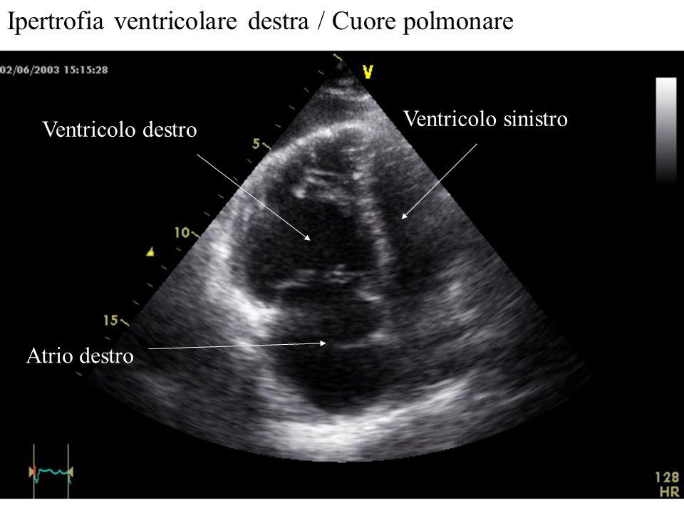Ipertrofia ventricolare destra / Cuore polmonare