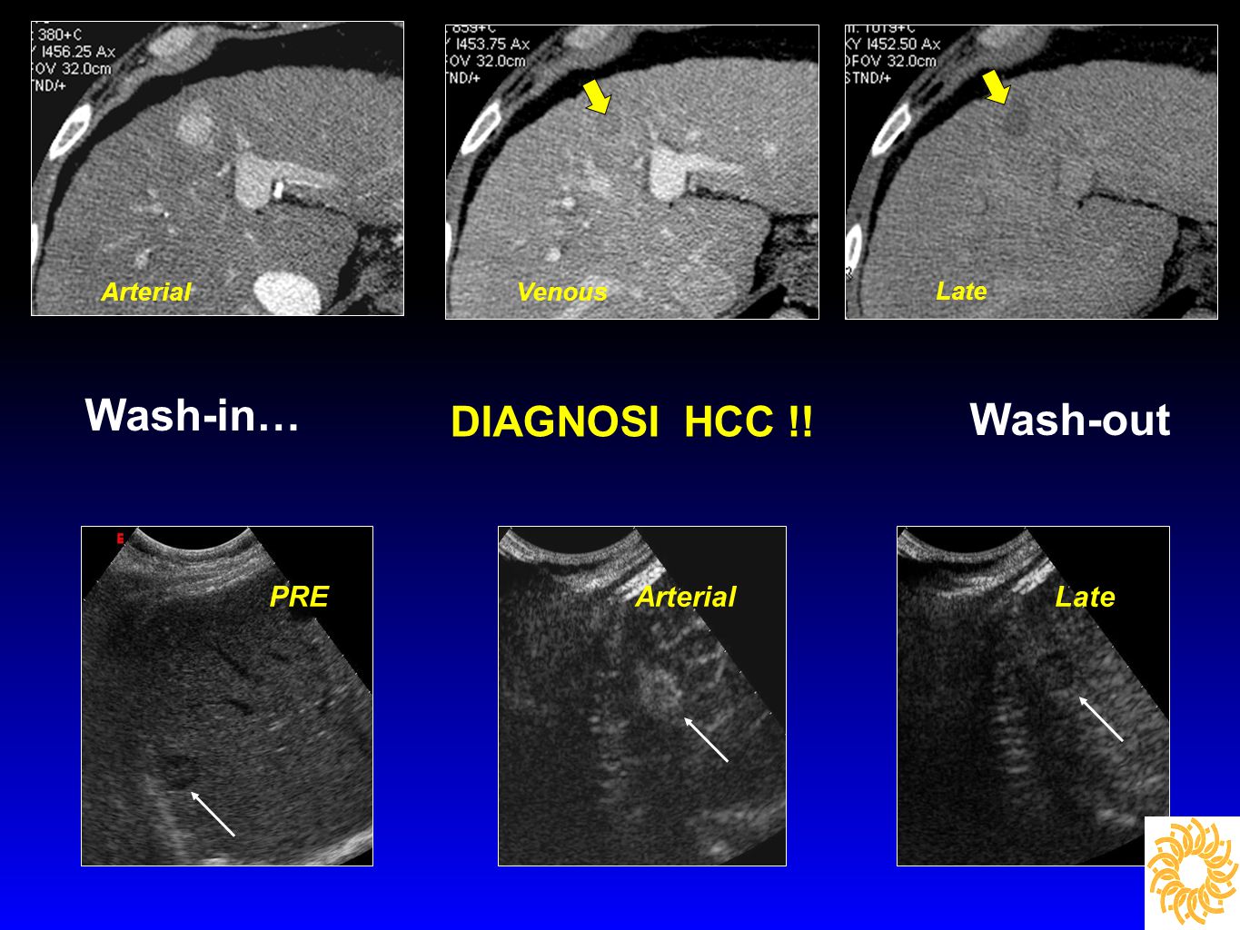 Wash-in… Wash-out DIAGNOSI HCC !! PRE Arterial Late Arterial Venous