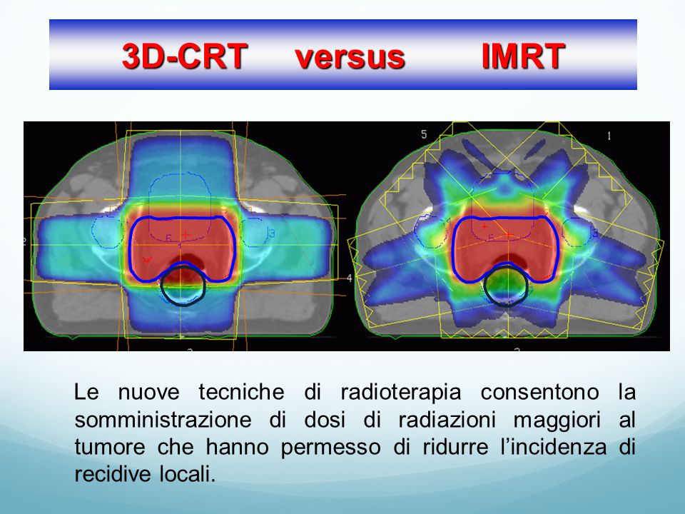 Конформная лучевая. Трехмерная конформная лучевая терапия (3d-CRT). IMRT терапия. Лучевая терапия с модулированной интенсивностью (IMRT). IMRT IGRT лучевая.